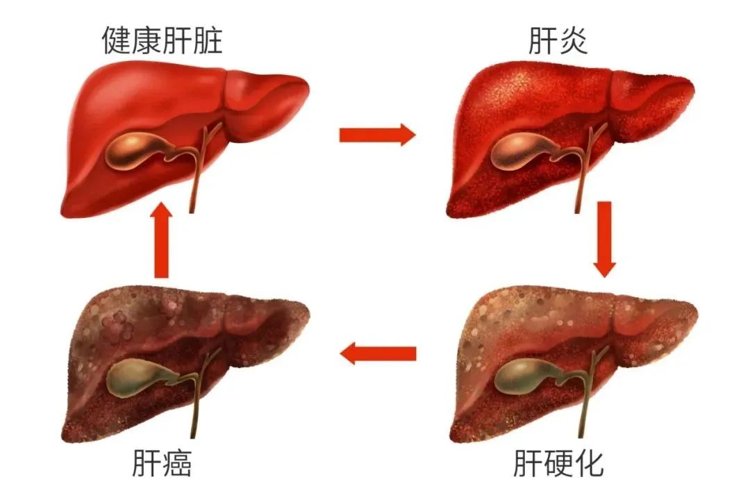 肝脏疾病通常会经历以下四个阶段