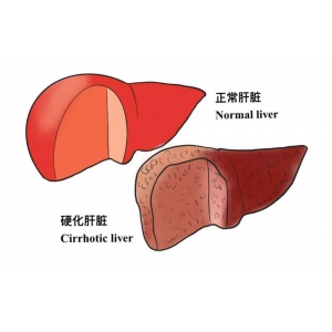 出现这些指标，说明你的肝硬化在好转