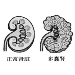 多囊肾会遗传吗?