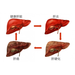 肝脏疾病通常会经历以下四个阶段