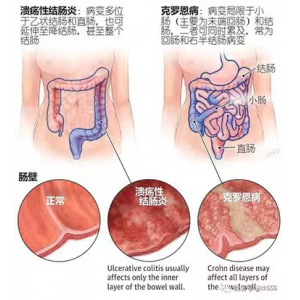溃疡性结肠炎、克罗恩病饮食禁忌大全