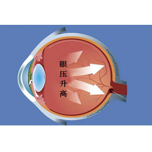 眼压高就是青光眼吗？