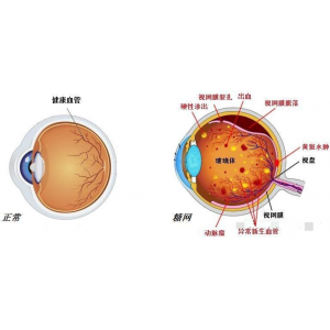 糖尿病视网膜病变
