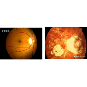 高度近视眼底病变