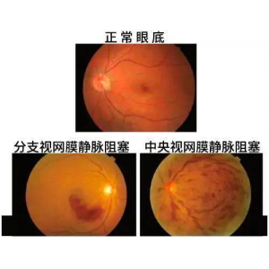 视网膜静脉阻塞