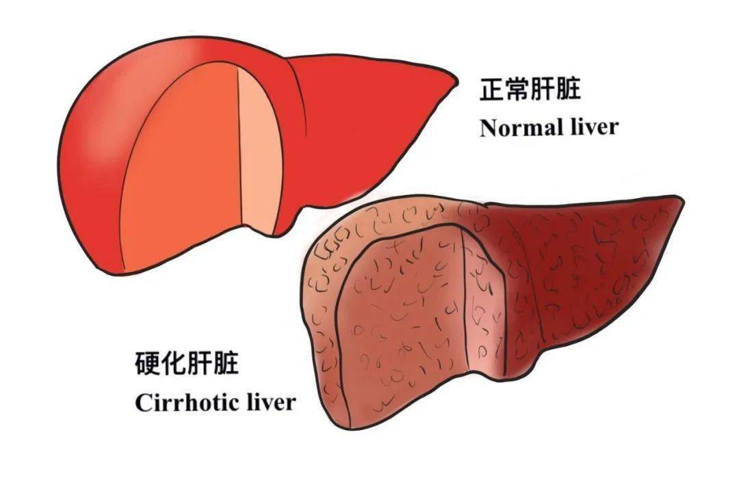 怎样知道肝硬化的严重程度？