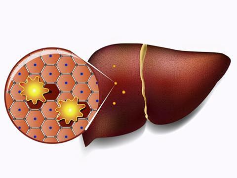 肝纤维化危害有哪些？预防肝纤维化应该怎么做？